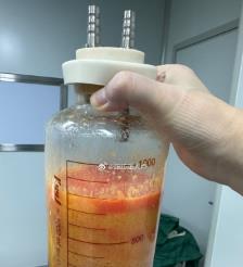 晋中水动力吸脂手术要做多久？